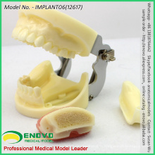 VENDRE le modèle de mâchoire de pratique de l&#39;implant 12617 avec la douille remplaçable